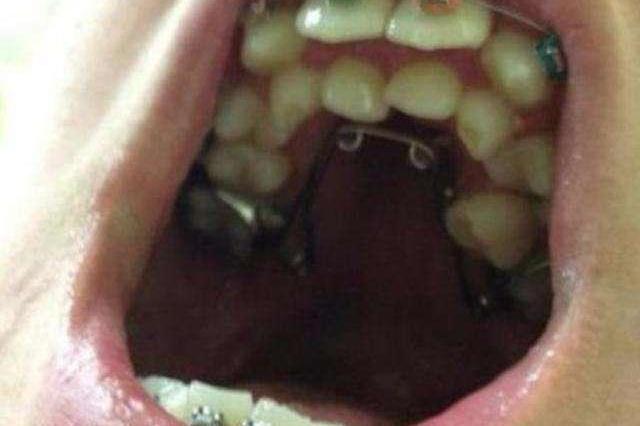 8岁小孩长出畸形双排牙听完牙医的诊断报告父母愣住了