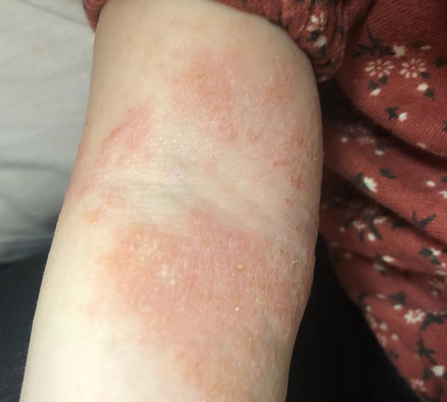 有没有简单的方法知道宝宝是湿疹还是特应性皮炎