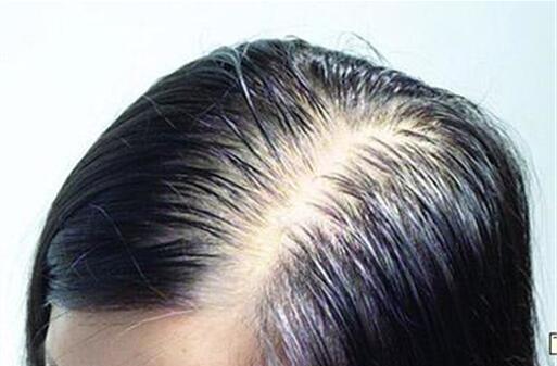 有5个症状, 说明头螨成灾, 日常1小方法灭了它