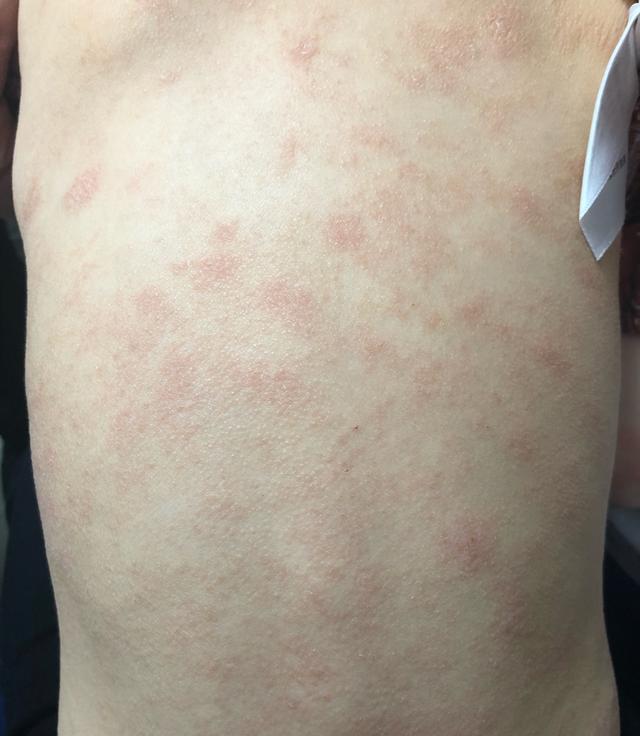 有没有简单的方法知道宝宝是湿疹还是特应性皮炎