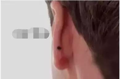 一颗黑痣没注意,非常值得看的一篇文章