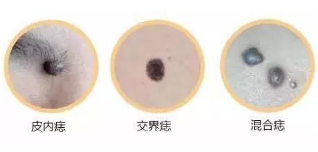 一颗黑痣没注意,非常值得看的一篇文章