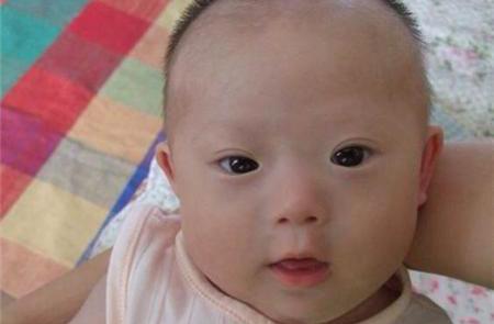 先天性愚型 新浪网