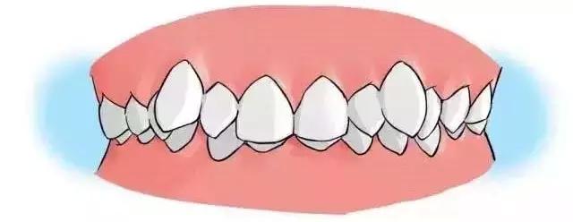 为什么虎牙会长得不好看? 矫正虎牙会影响进食