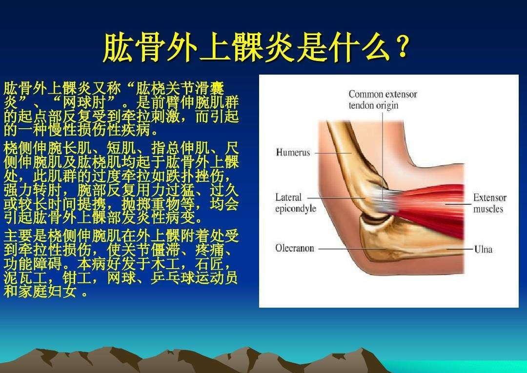 网球肘是怎么回事? 该怎么办?