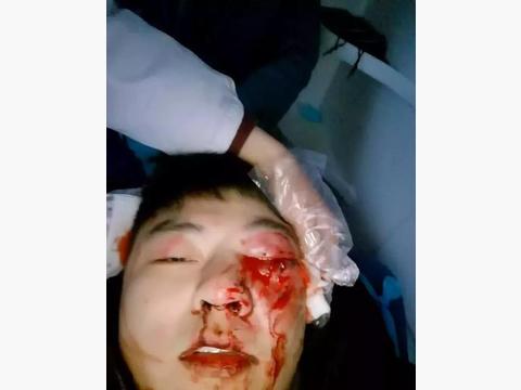 恐！怖！别克凯越安全气囊成炸弹，徐州一车主眼睛被炸“瞎”！