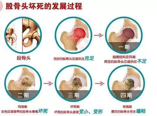 南阳市第一人民医院科普丨正确认识“股骨头缺血性坏死”