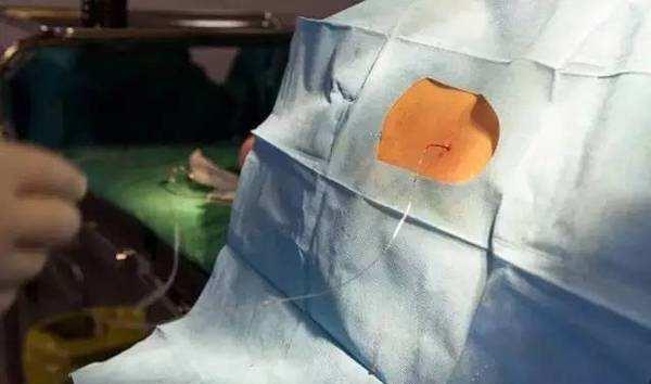 剖腹产打麻醉后, 产妇有啥感觉, 经历过的妈妈们这样说