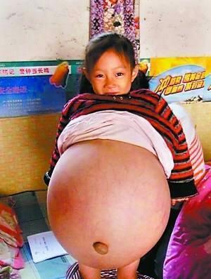 刚上小学的小姑娘肚子大的像个球! 医院检查后爸爸都接受不了!