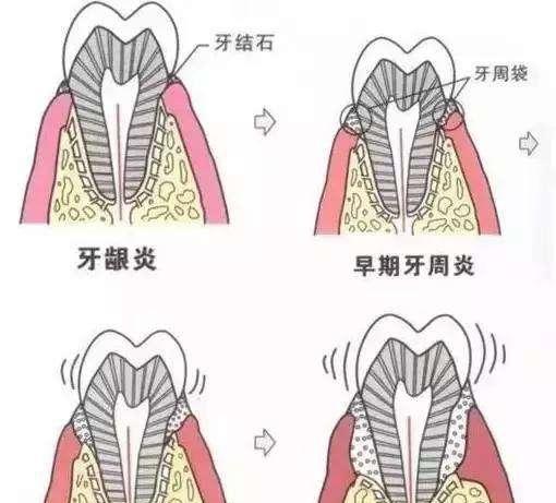 6-12岁儿童也要积极防治牙龈炎和牙周炎