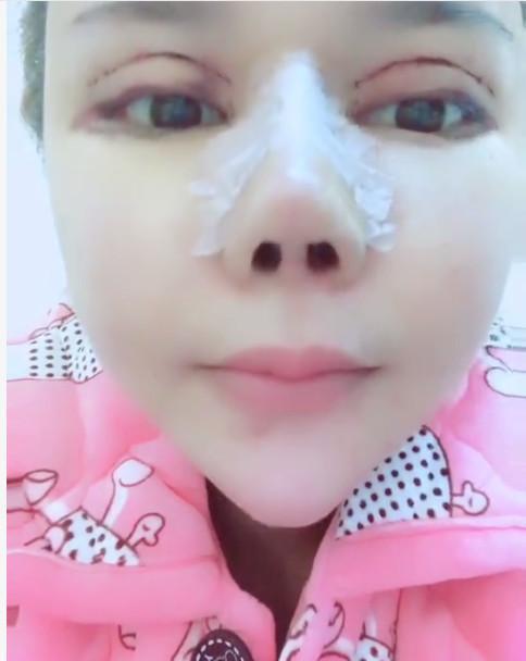 长相甜美的95后女孩, 想不开去整容, 没想到整成了“猪鼻子”