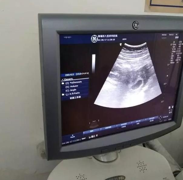 孕囊呈现椭圆形为男孩靠谱吗?