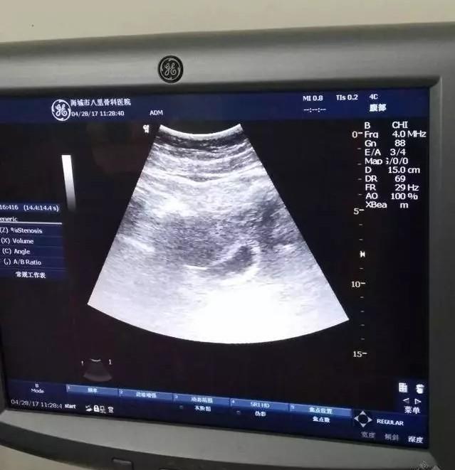 男宝宝b超分享? 孕囊呈现椭圆形为男孩靠谱吗?