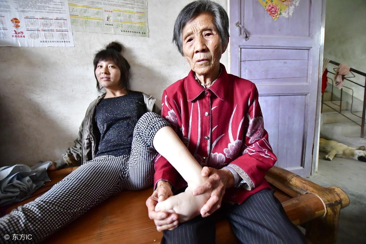 女子5岁高烧落下疑似缩筋症的怪病, 八十多岁