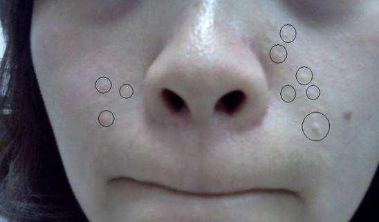 日常做到这5点, 闭口粉刺会自动消失不见