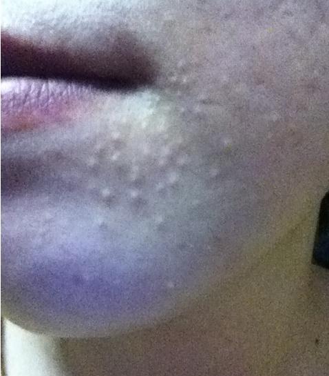 黑头粉刺形成原因 如何有效祛除黑头