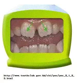 孩子换牙,长出的新牙又大又歪,怎么整?