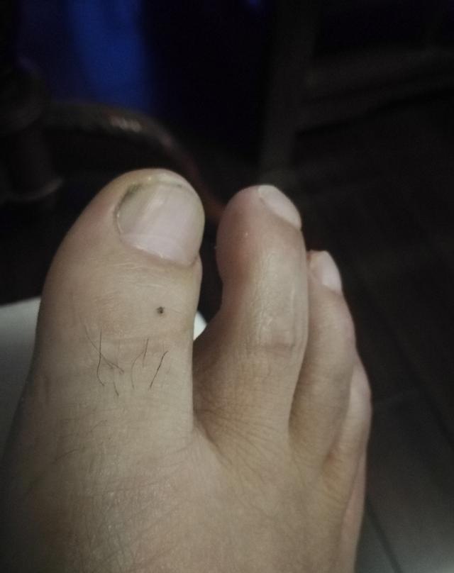 相术:图解--脚上长痣