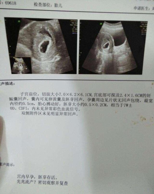 b超单看孕囊形状
