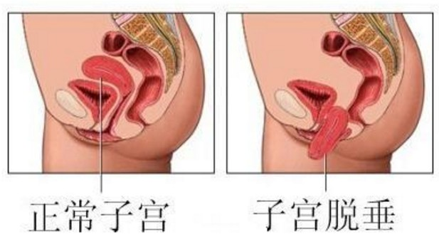 子宫脱垂的艾灸调理方法(41)