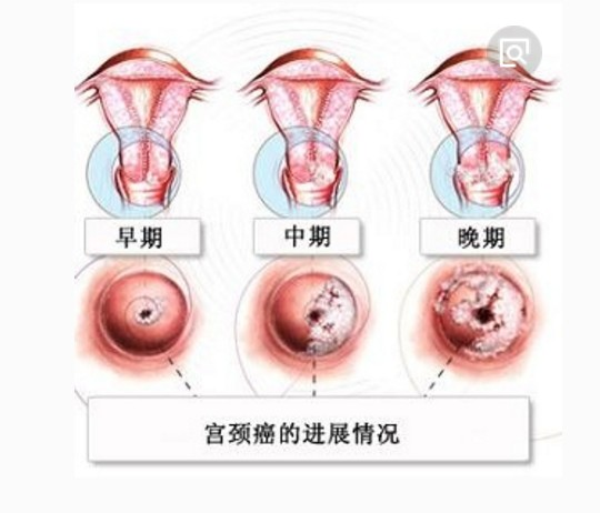 中医能治癌症吗?