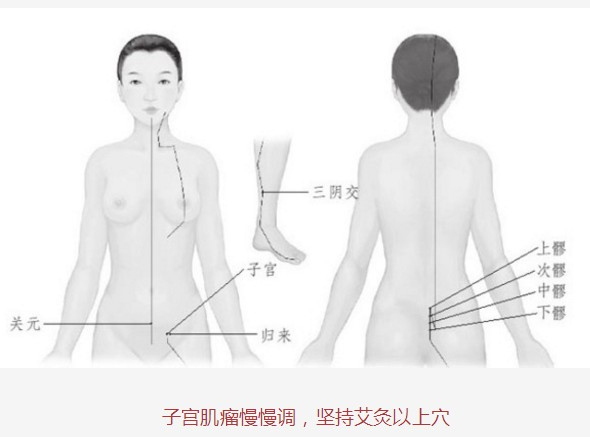 子宫肌瘤,求一求艾灸(43)