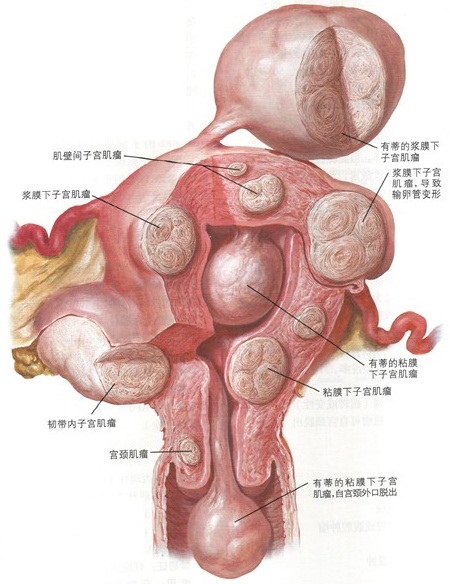 子宫肌瘤,求一求艾灸(43)
