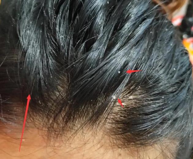 头发油腻腻,不是没洗干净,是有它存在,巧用3招变清爽