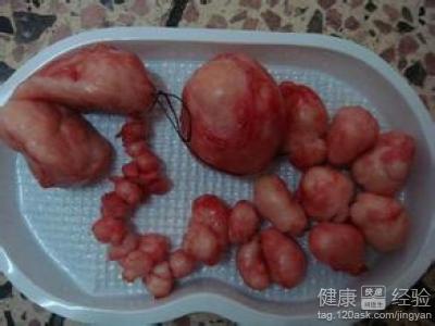 子宫肌瘤,求一求艾灸(43)
