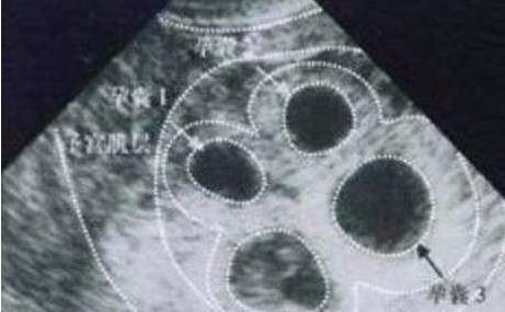 十九岁少女怀孕五个月肚子却如此大!医生检查