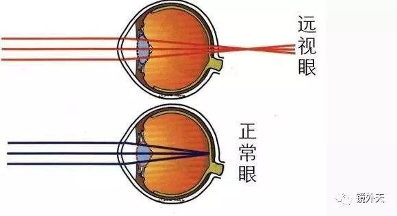 远视的原理？危害？如何快速的发现远视并改善？