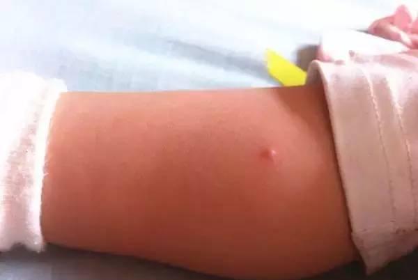 4个月宝宝长水痘，居然是亲妈害得!