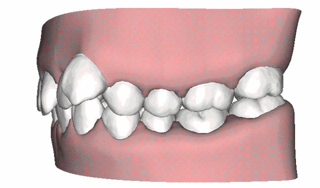 牙齿矫正前,您要想清楚这4件事!