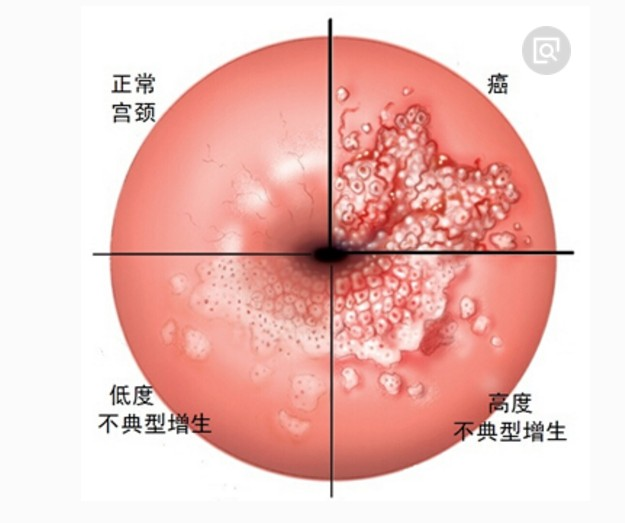 中医能治癌症吗?