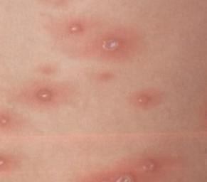 手,足等远端部位出现或平或凸的斑丘疹(下图)或疱疹,初起为斑丘疹,后