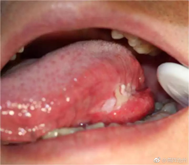 29岁小伙口腔溃疡两月都没好去医院检查:原来这是舌癌