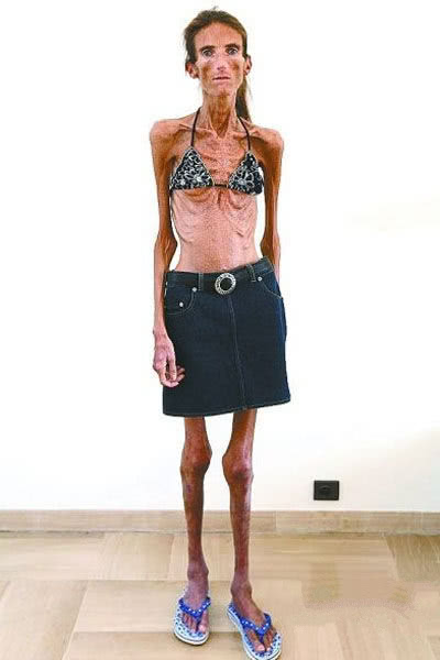 她是世界上最瘦的女人,体重仅27公斤,10多年没有吃过一片面包