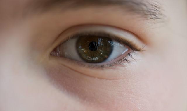 眼部脂肪粒怎么去除 六种实用技巧赶紧get