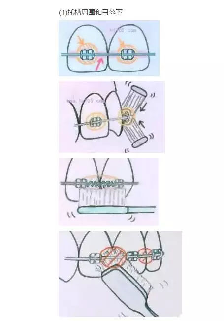 正畸医生任欢解析:牙齿矫正过程中正确的刷牙