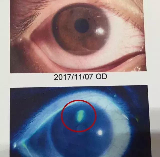 3岁宝宝手中这种常见物品,竟让妈妈角膜破了个洞