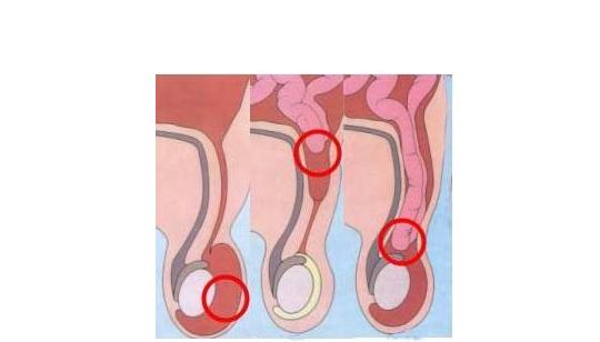 两岁男童被迫切除睾丸,疝气到底是个什么东西