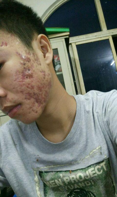 青春期时长痘, 脸上的痘印痘坑怎么去除?