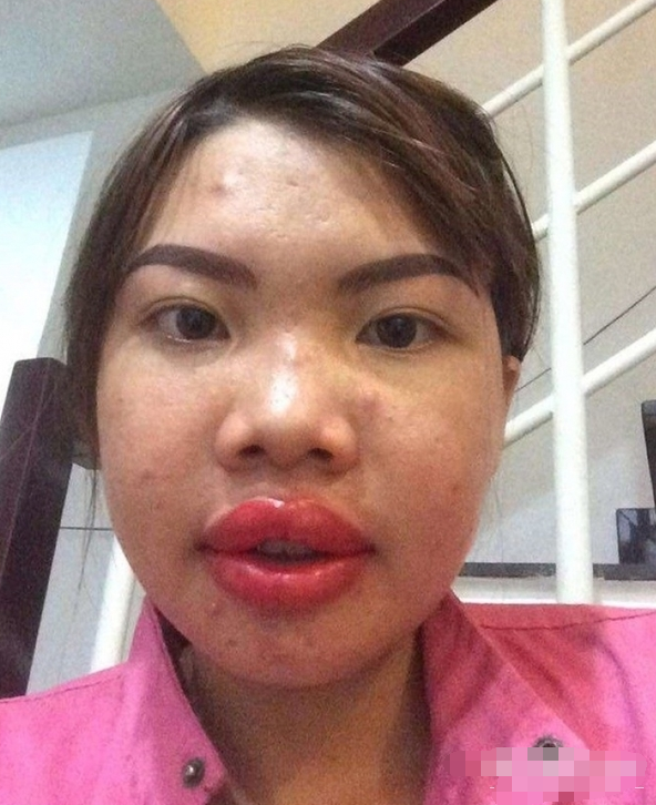 泰国28岁女子因丑陋无人敢娶,整容后变女神嫁给富二代