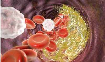 甘油三酯高,身体会出现4个预警信号,逼退甘油