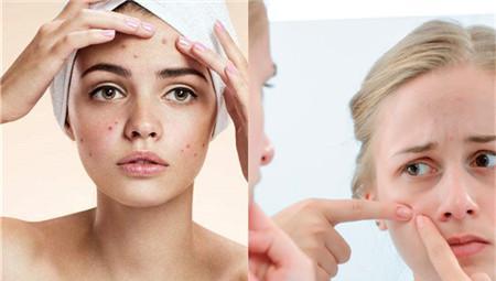 脸上长脓包型痘痘是什么原因 不可忽视这几点