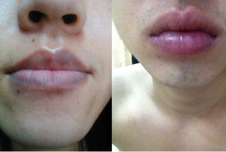 嘴唇周围黑色素沉淀是什么原因 该如何改善