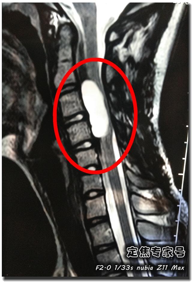 上小学女儿脖子针扎一样疼痛,千钧一发之际才