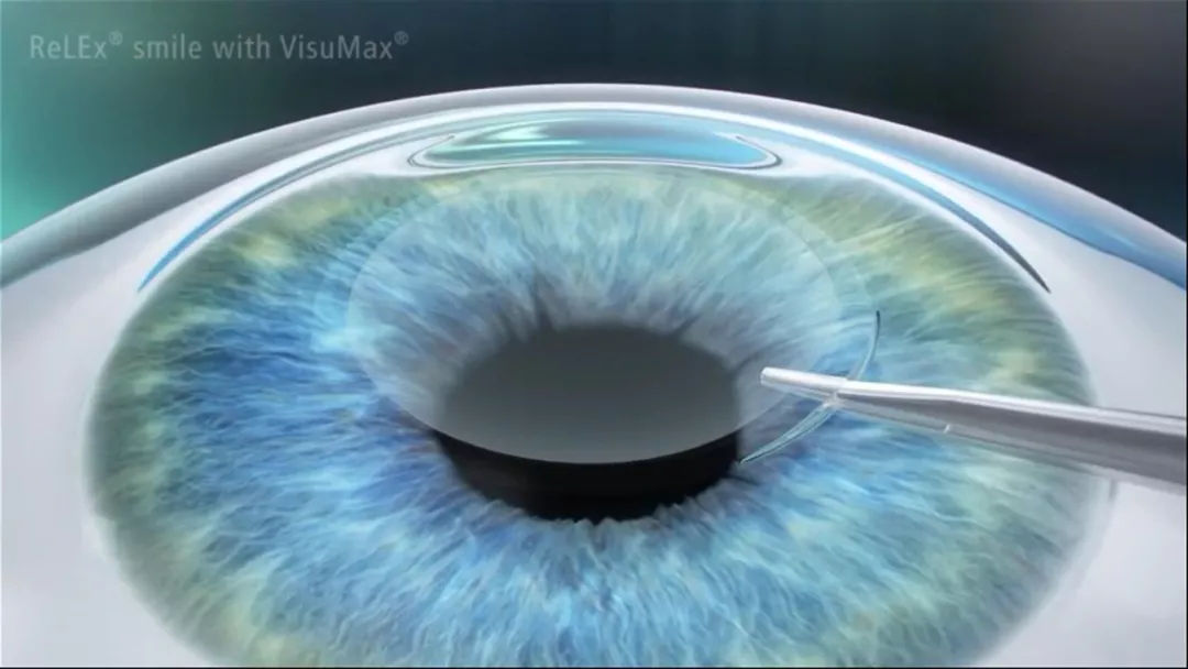 【芜湖全飞秒】、半飞秒、准分子区别，医生不告诉你的秘密
