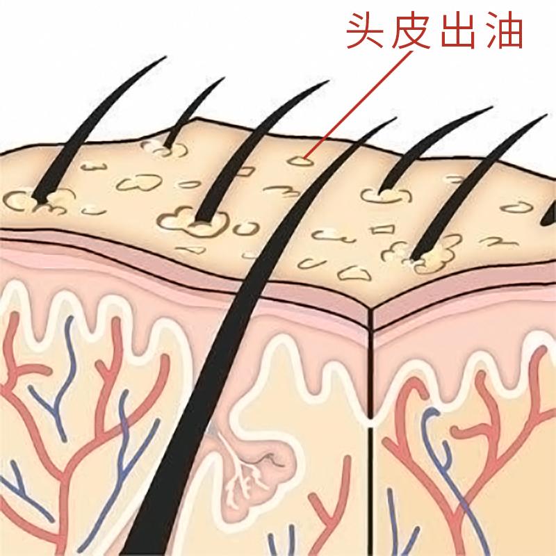 夏天头发油腻,脱发严重,不能多洗头,但可以这样
