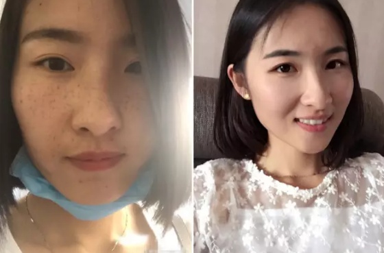 不要以为去医院祛斑就能好,不做好这几点话,斑